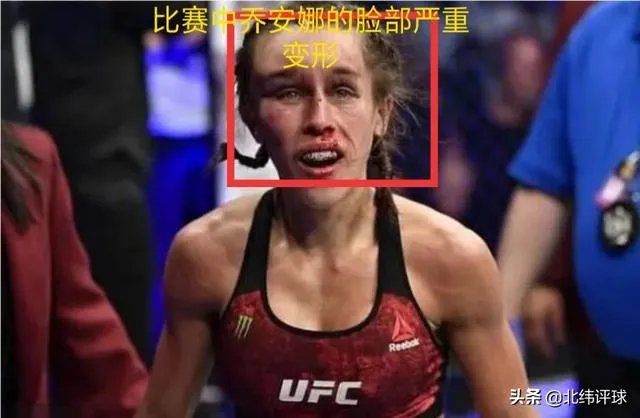 UFC冠军赛后，乔安娜需要进行整形手术而张伟丽却完全不需要，这是为什么？你怎么看？