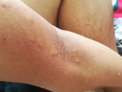 跳蚤叮咬胳膊小疙瘩图片