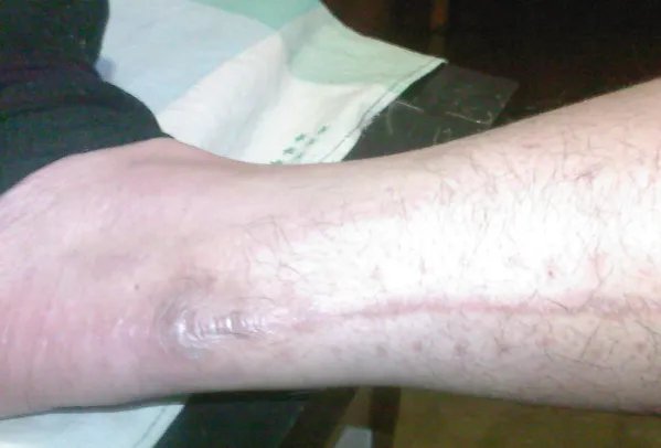 小伙身高不足一米八断骨增高致残疾，断骨增高手术具体咋做的？