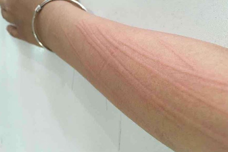 人工性荨麻疹图片和症状