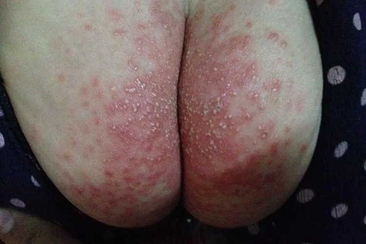 新生儿尿布湿疹图片大全