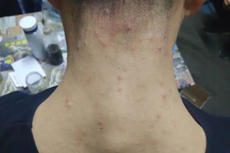 颈部长疙瘩图片