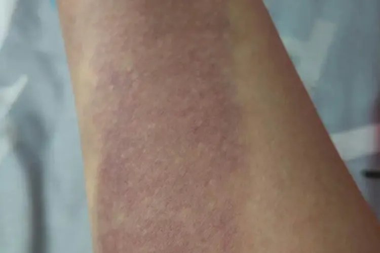 打排球手臂肿胀青紫图片