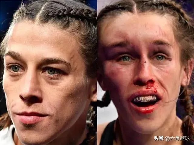 UFC冠军赛后，乔安娜需要进行整形手术而张伟丽却完全不需要，这是为什么？你怎么看？
