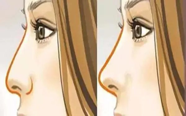 成都哪家医院做玻尿酸隆鼻好