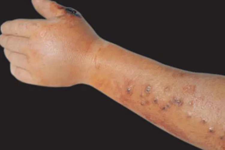 人体皮肤炭疽病图片