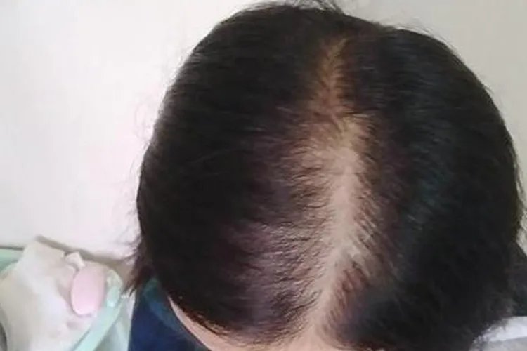 发缝多宽算脱发图片