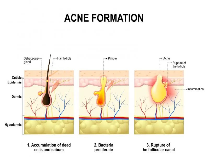 额头毛孔粗大怎么办