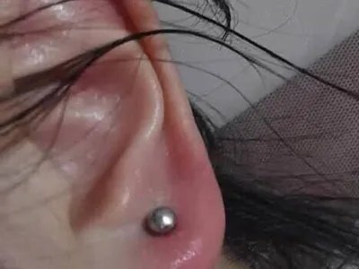 镍皮炎耳部红肿图片