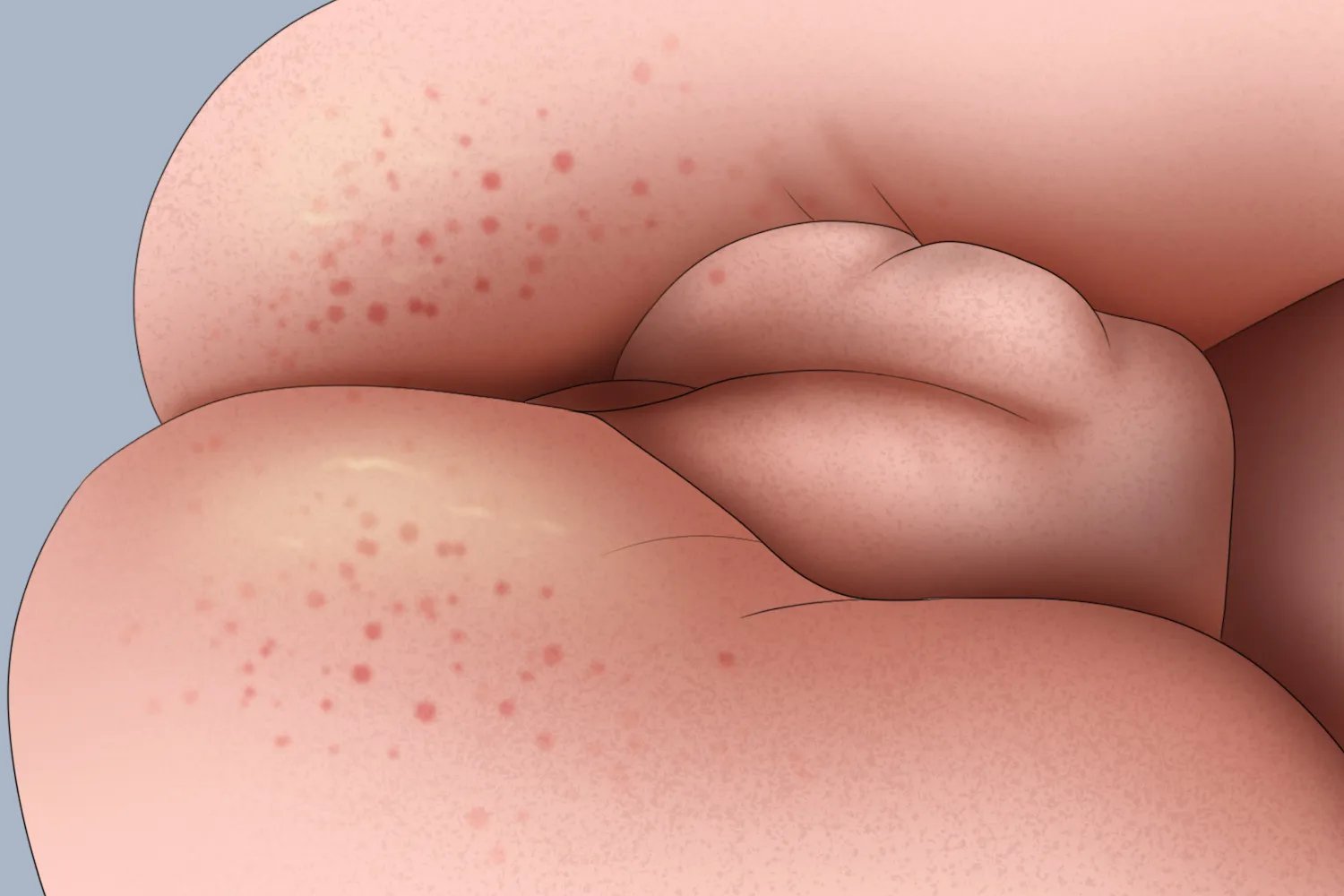 新生儿尿布湿疹图片大全