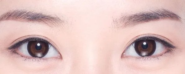 双眼皮埋线的坏处