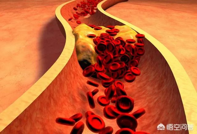 血管堵塞,身体会发出哪些求救信号?吃什么食物可以疏通血管?