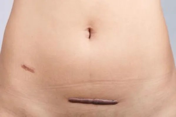 剖腹产后疤痕如何修复 四大妙招修复剖腹产疤痕