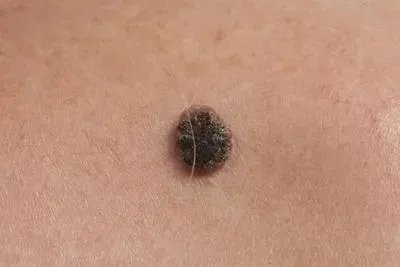 黑色素瘤的治疗方法有哪些 认清黑色素瘤的五大治疗方法