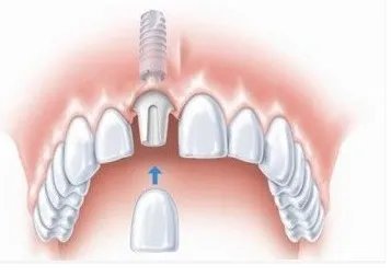 广州种植牙多少钱一颗