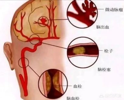 血管堵塞,身体会发出哪些求救信号?吃什么食物可以疏通血管?