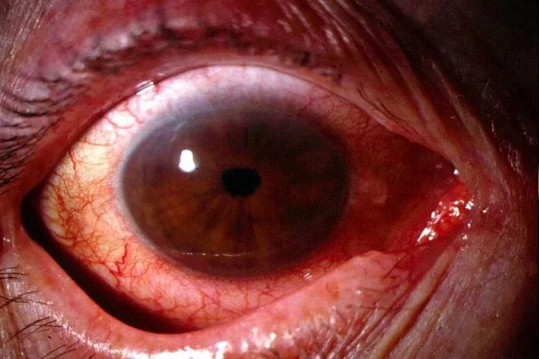 眼睛疾病大全图解