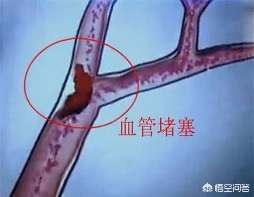 血管堵塞,身体会发出哪些求救信号?吃什么食物可以疏通血管?