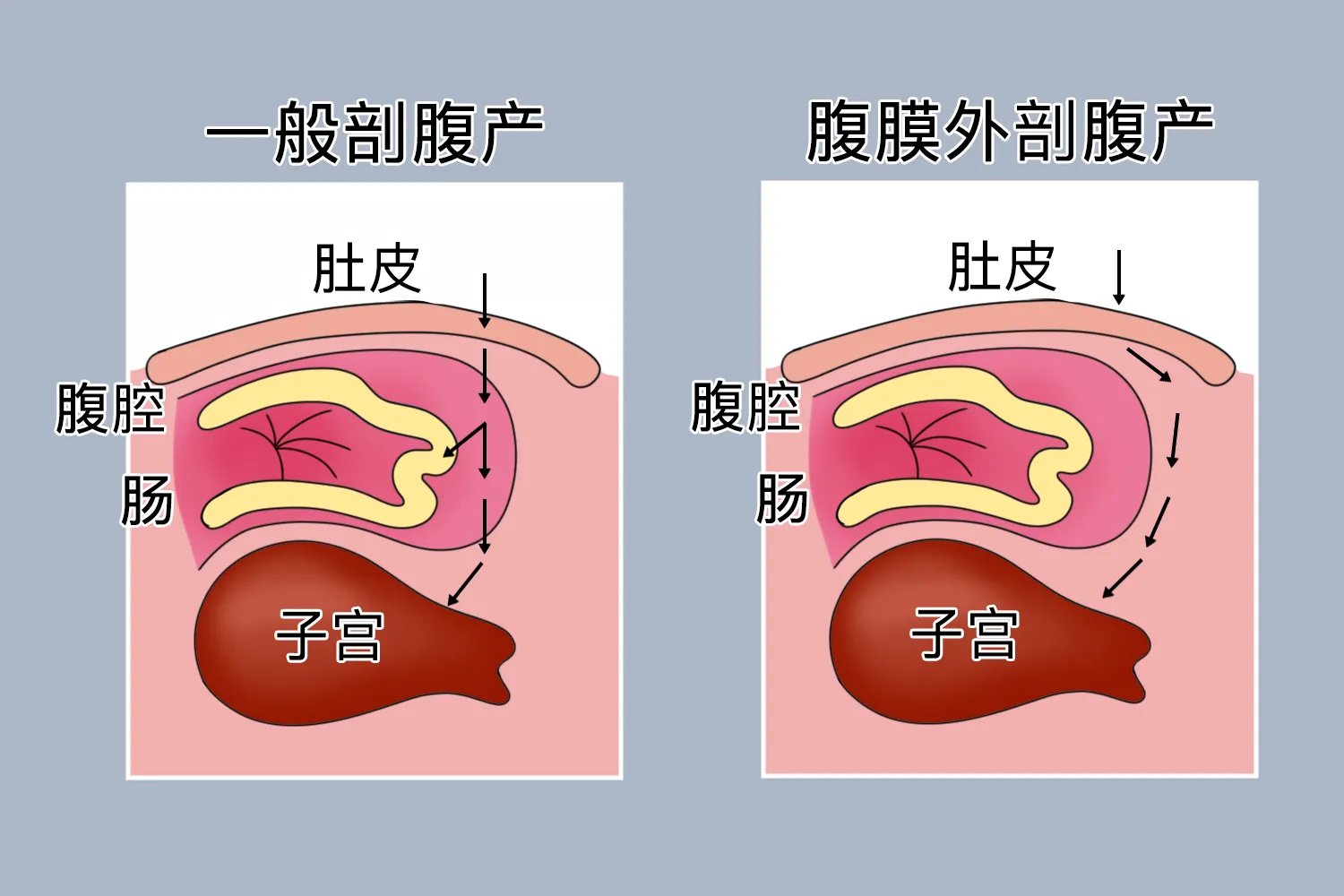 剖腹产的刀口位于子宫哪里图