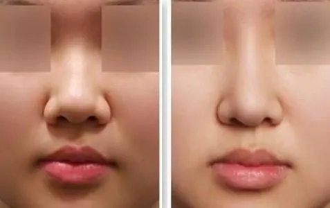 玻尿酸隆鼻多少钱一针