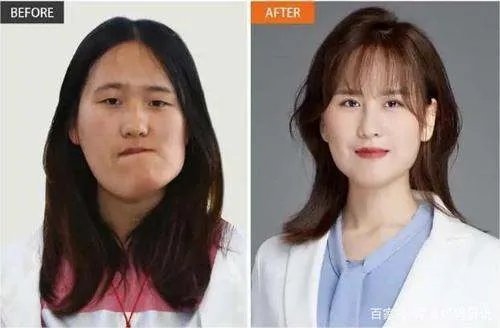 歪脸女孩赵宏秋整容成功后舍百万年薪当老师，后来怎样了？