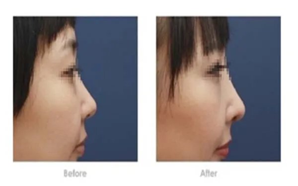 成都哪家医院做玻尿酸隆鼻好