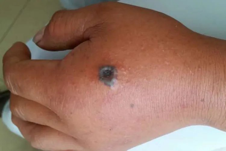 人体皮肤炭疽病图片