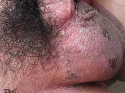 阴囊湿疹样癌结痂图片