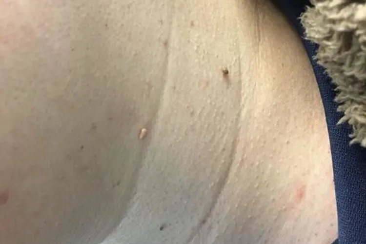 颈部长疙瘩图片