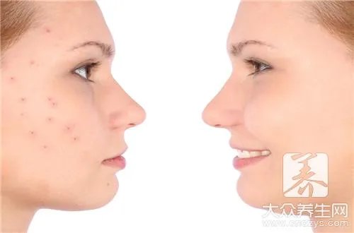 祛痘去痘印最快最有效的方法是什么？