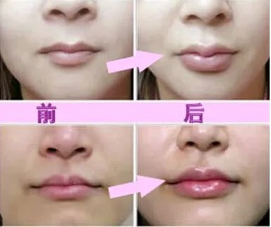 玻尿酸丰唇费用是多少