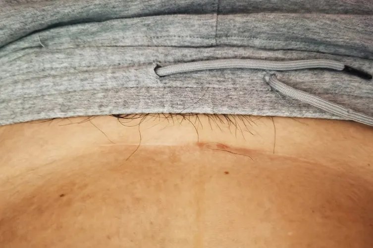 剖腹产伤口疤痕增生图片