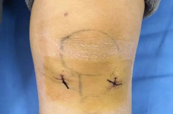 小伙身高不足一米八断骨增高致残疾，断骨增高手术具体咋做的？