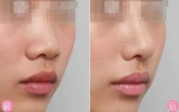 成都哪家医院做玻尿酸隆鼻好