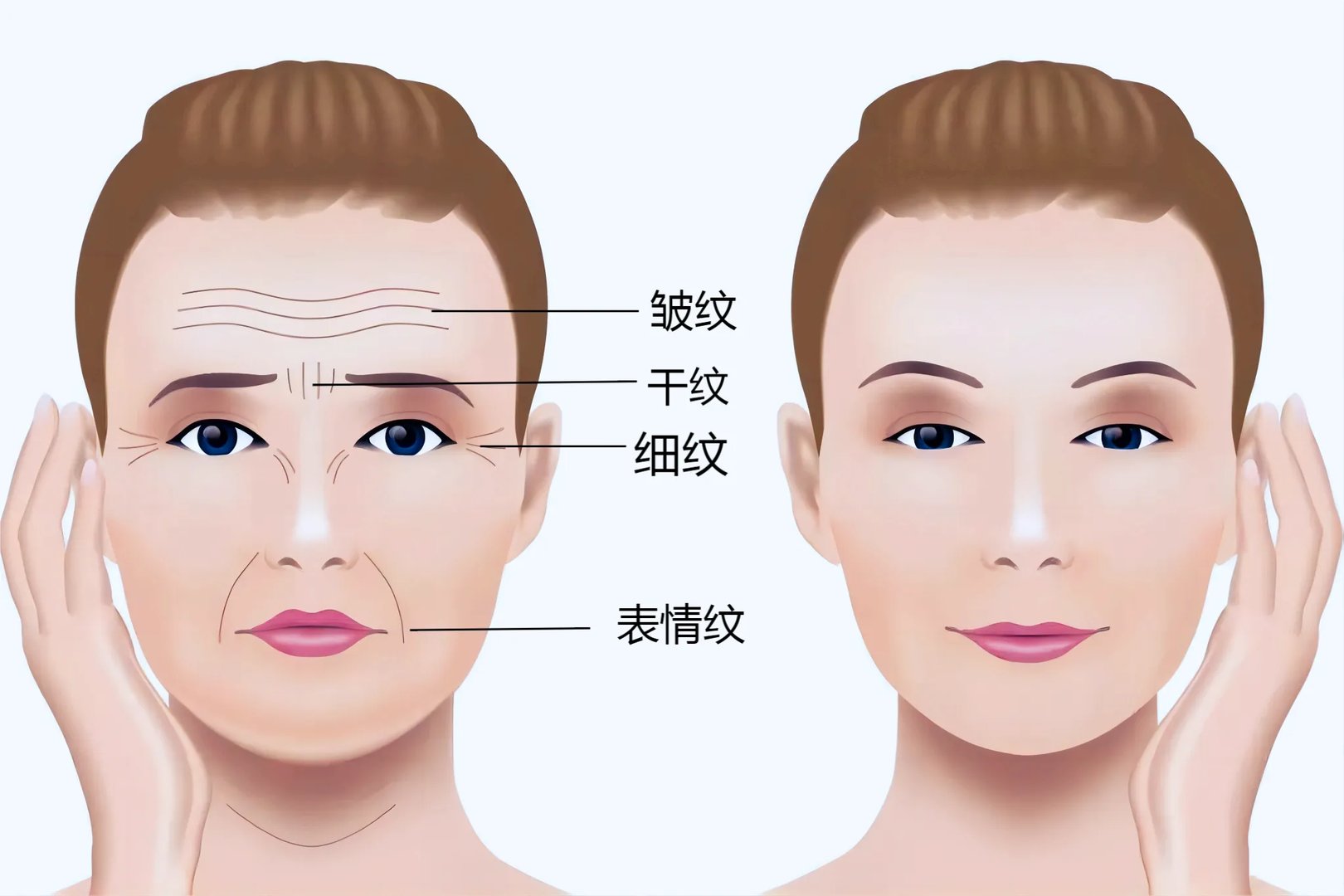 眼纹有哪几种图片