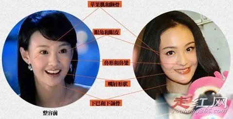 郑爽整容了吗 取出假体前后对比照片