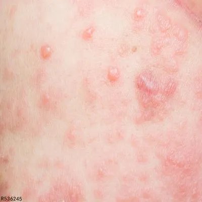 洪水接触对皮肤有什么影响