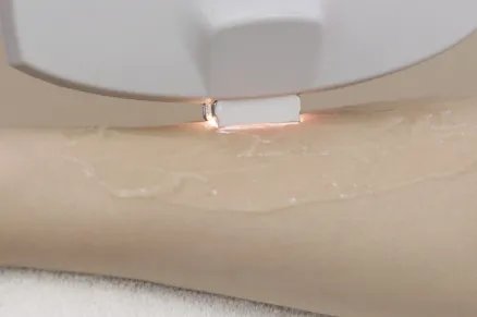 小腿激光脱毛步骤