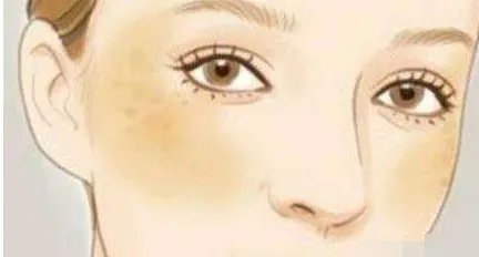 彩光祛斑用多少钱