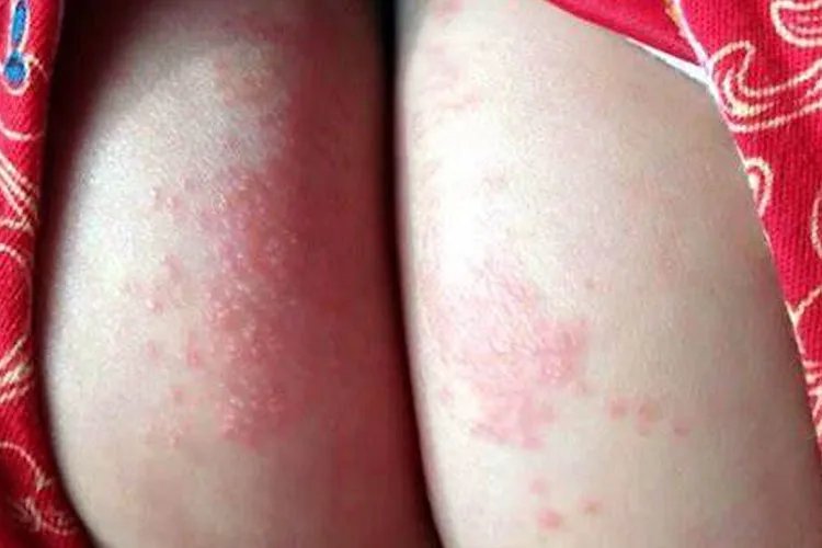 新生儿尿布湿疹图片大全