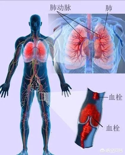 血管堵塞,身体会发出哪些求救信号?吃什么食物可以疏通血管?