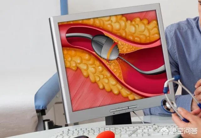 血管堵塞,身体会发出哪些求救信号?吃什么食物可以疏通血管?