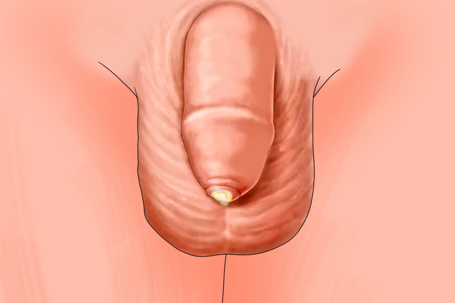 什么情况需要割包茎手术图片