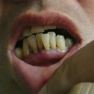 牙疼怎么办立刻止疼