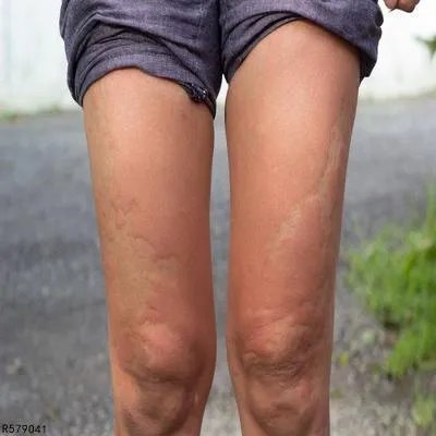 膝关节响是怎么回事 盘点膝关节响的四大真相