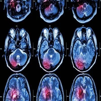 高原脑水肿怎么诊断及治疗