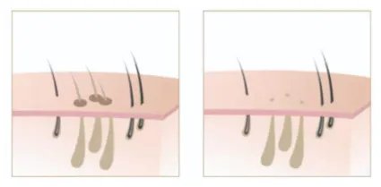 一般永久脱毛要多少钱