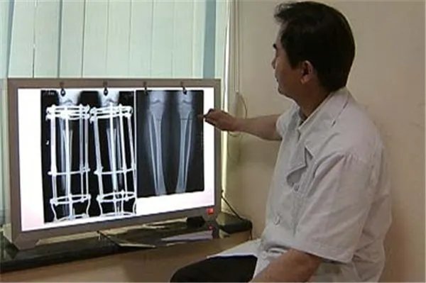 小伙身高不足一米八断骨增高致残疾,为何增高手术会致残?