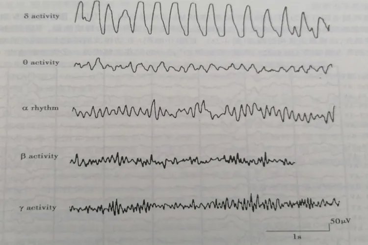 小儿正常脑电图报告单图片