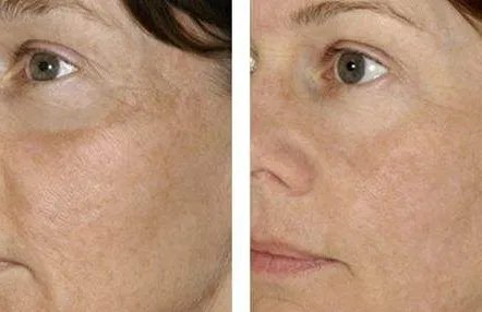 玻尿酸多少钱一支价格表